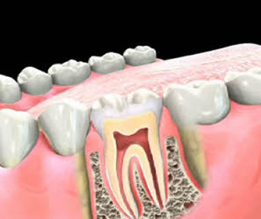 Private: Do You Need a Root Canal Procedure?