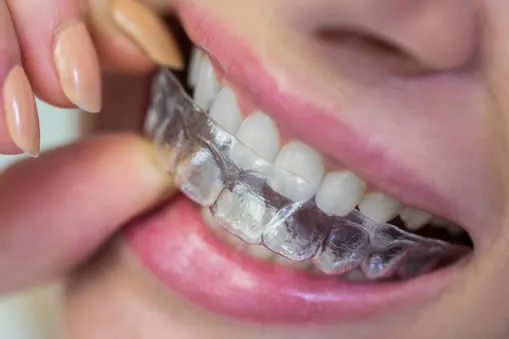 invisalign clear aligner on teeth