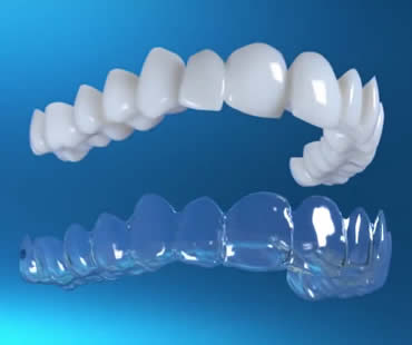 Private: Frequently Asked Questions About Invisalign